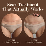 Nēmah Renewing Scar Cream