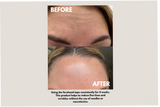 Seald™ Forehead Tape – Wrinkle Smoothing Patches